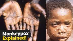 5 Things You Need to Know about Monkeypox Right Now!