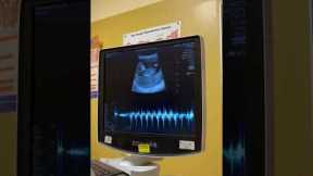 Ultrasound shows baby letting out a large fart