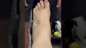 Pregnant Woman Shocked At Foot Swelling